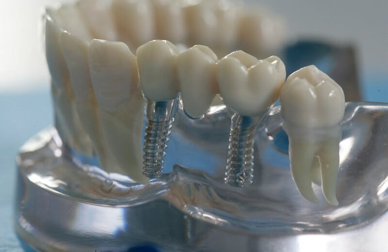 diş implantı